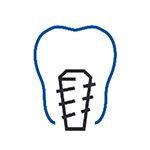 Zygomatic Implants
